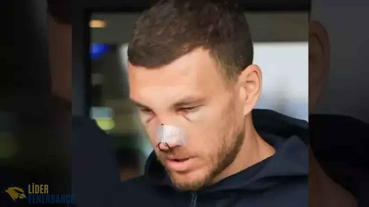Dzeko Kırık Burun