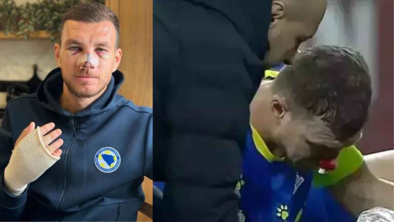 Edin Dzeko ameliyat olmayacak